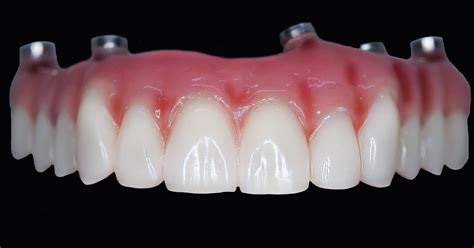 affordable all-on-4 dental implants